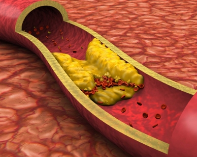 Malaltia coronària / Obstrucció de les artèries coronàries
